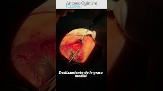 Blefaroplastia Inferior Subciliar con “Reposición de la Bolsa de Grasa Central” [upl. by Apurk]