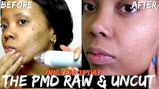 THE PMD  REAL RESULTS ONE YEAR UPDATE  RAW amp UNCUT BEFORE  AFTER MUST SEE  TASTEPINK [upl. by Yardna]