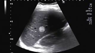 Ultrasound Video showing hemangioma in Liver [upl. by Ernald]