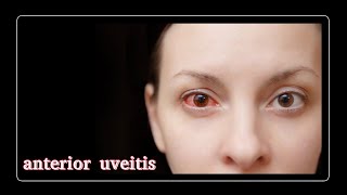 anterior uveitis [upl. by Nyvlem295]