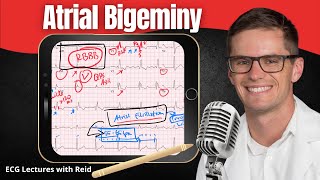 Atrial Bigeminy EKG  ECG Lecture [upl. by The]