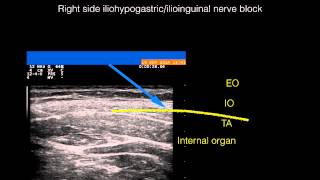 Ultrasound guided right side ilioinguinaliliohypogastric nerve block [upl. by Nido]