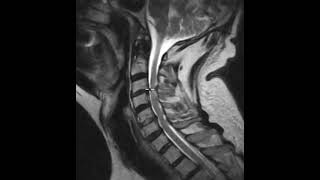 Cervical canal stenosis and spinal cord atrophy [upl. by Gotthelf]