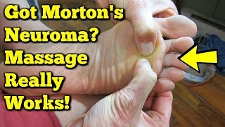 Mortons Neuroma Massage  Exercises to AVOID Surgery [upl. by Hurless741]