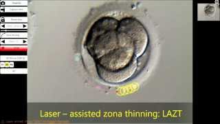 Laser  assisted zona thinning LAZT [upl. by Barthol]