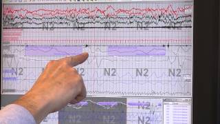 Reading Sleep Study Results Identifying Sleep Apnea [upl. by Ahseka]