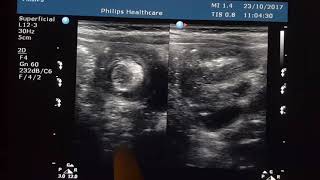 Intussusception Sonography with Explanation [upl. by Enneyehs]