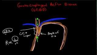 Pathophysiology of Gastroesophageal Reflux Disease GERD [upl. by Valentia]