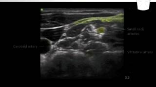 Cervical Plexus Block  Nerve Localization [upl. by Loziram461]