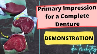 Primary Impression for a Complete Denture  Demonstration Super Simple [upl. by Vallie]