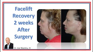 Facelift Recovery After 2 Weeks [upl. by Ackler]