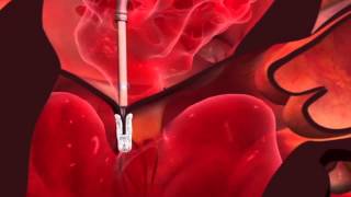 Mitral Valve Regurgitation Treatment [upl. by Meesaw625]