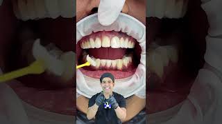 Secrets of Perfect Smile Transformation  Expert Tips for Veneer Smile Makeover [upl. by Macrae87]