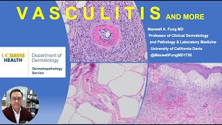 DERMATOPATHOLOGY Vasculitis Vasculopathy amp More [upl. by Omland]