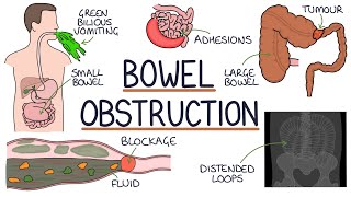 Understanding Bowel Obstruction [upl. by Mushro]