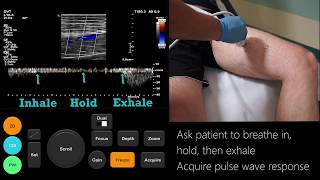 Ultrasound Tutorial DVT  Lower Limb Veins  Radiology Nation [upl. by Cran]