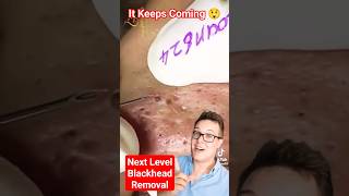 NEXT LEVEL BLACKHEAD REMOVAL  It Just Kept Coming shorts [upl. by Birdt]