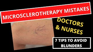 Microsclerotherapy 7 Mistakes to Avoid  Tips for Success [upl. by Inaj]