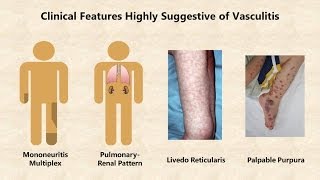 Vasculitis  An Overview [upl. by Burnside]