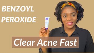 Acne Treatment  How to use BENZOYL PEROXIDE for ACNE  Dr Janet [upl. by Venetia]