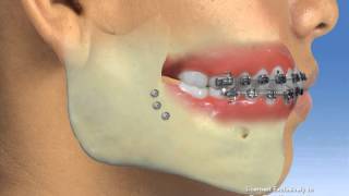 Orthodontics  Surgery [upl. by Weisbrodt]