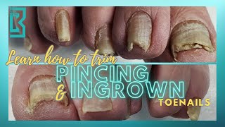 Pincer and Ingrown Nail Care Tutorial [upl. by Ramos]