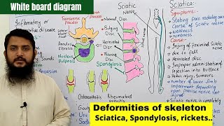 Deformities of skeleton part 02  Disc Slip  Spondylosis  Sciatica  Arthritis [upl. by Ssitnerp915]