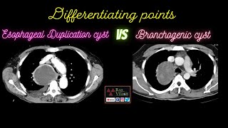 ESOPHAGEAL DUPLICATION CYST VS BRONCHOGENIC CYST [upl. by Sitoiyanap]