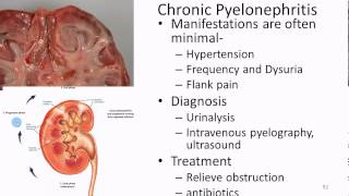 Pathophysiology Renal 3 UTI Acute and Chronic [upl. by Ojibbob]