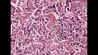 Histopathology LiverCholangiocarcinoma moderately well di [upl. by Sumetra]