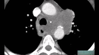 56yoM CXR CT Chest Adenopathy Discussed by Radiologistmp4 [upl. by Hedaza947]