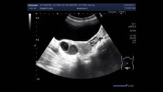 Ultrasound Video showing difference between the simple and hemorrhagic ovarian cysts [upl. by Divadnahtanoj]