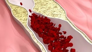 ¿Cómo y por qué ocurren los derrames cerebrales [upl. by Jaymee]