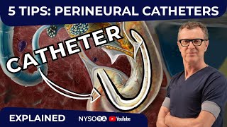 5 TIPS PERINEURAL CATHETERS  Crash course with Dr Hadzic [upl. by Ferriter]