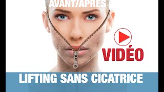 LIFTING SANS CICATRICE  AVANTAPRÈS vidéo médicale officielle [upl. by Agnimod391]