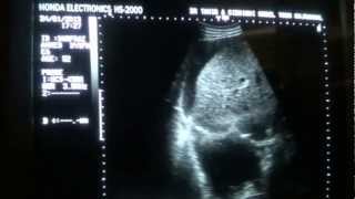 ASCITIC vs PLEURAL FLUID differentiation by ultrasound [upl. by Chiang]