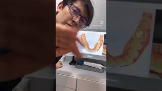 Valoración dental con tecnología scanner invisalign dentista ortodoncia ortodonciainvisible [upl. by Levitus]