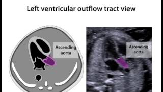 Left Ventricular Outflow Tract View 119 [upl. by Acissj25]