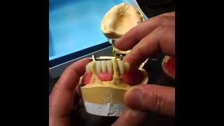 Full Upper  Partial Lower Denture with Cusil Set Up Ready for Try In [upl. by Querida]