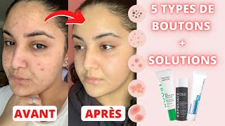 LACNÉ  MA ROUTINE SKINCARE  TOUTES LES SOLUTIONS POUR CHAQUE TYPE DE BOUTON [upl. by Kimon73]