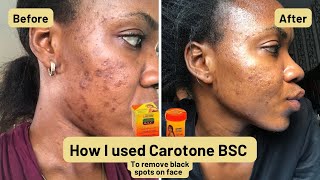 How to get clear skin Carotone Black Spot Corrector  How I truly got rid of my hyperpigmentation [upl. by Hluchy462]