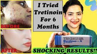 Retino A 0025cream Review  Before And After Tretinoin Cream Review  My experience with Tretinoin [upl. by Ellata952]