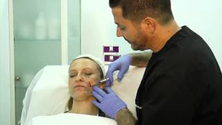 Tratamiento facial con Sculptra [upl. by Lodhia685]