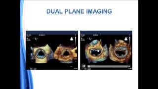 Guidelines for Performing a Comprehensive Transesophageal Echocardiographic Examination [upl. by Iramat]