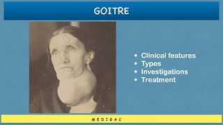 Goitre  Clinical features  EthologyCauses  Types  Investigations  Treatment [upl. by Dilks]