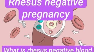 Rhesus negative pregnancy Rezus manfiy homiladorlik Резусотрицательная беременность [upl. by Roseann299]