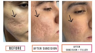 Subcision  Filler for Acne Scars [upl. by Halonna]