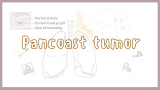 Clinical Review on Pancoast tumor from MyClinicalBook [upl. by Cerallua]