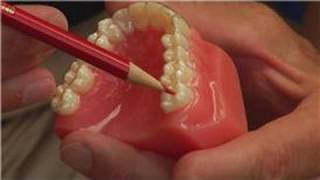 Tooth amp Gum Abscesses  How Dentists Drain an Abscessed Tooth [upl. by Lehcyar441]