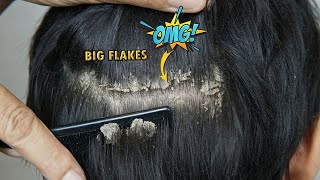 Combing And Scratching Dandruff Off Scalp 1174 [upl. by Otsirave]